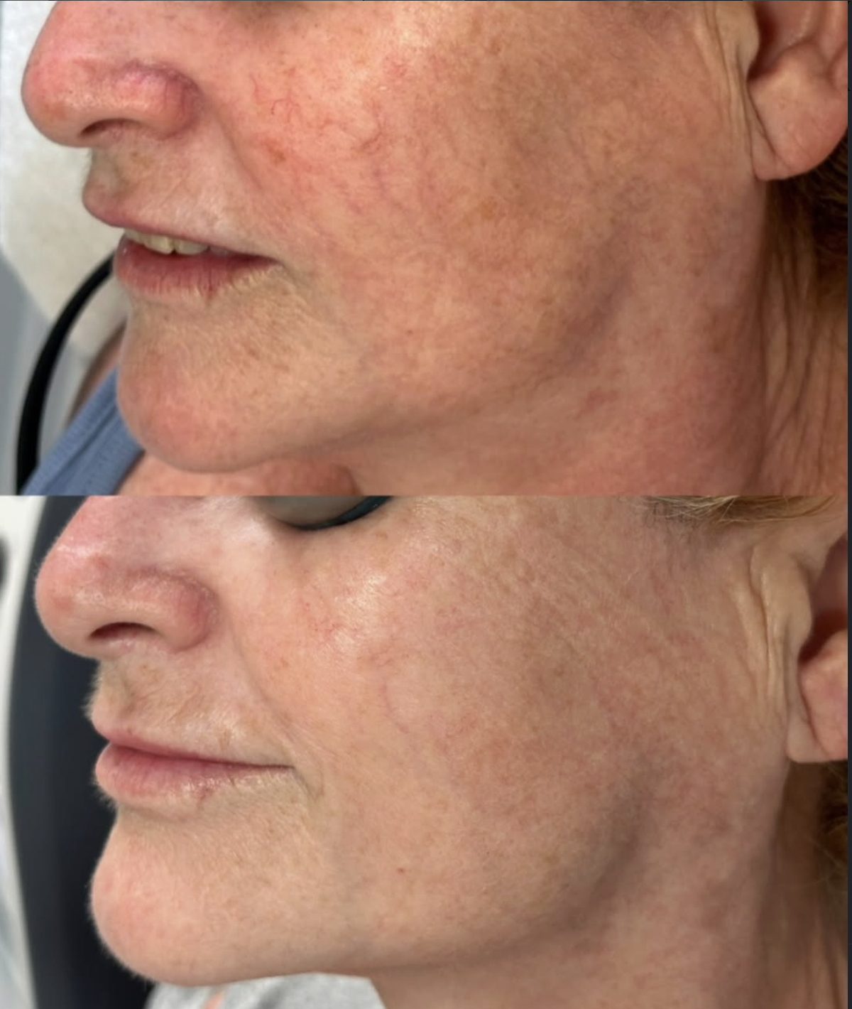 Redness + skin texture